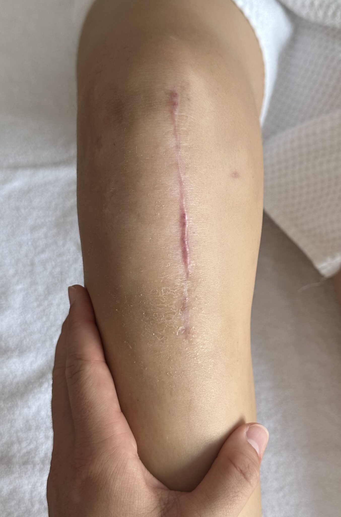 Narbenbehandlung Knie