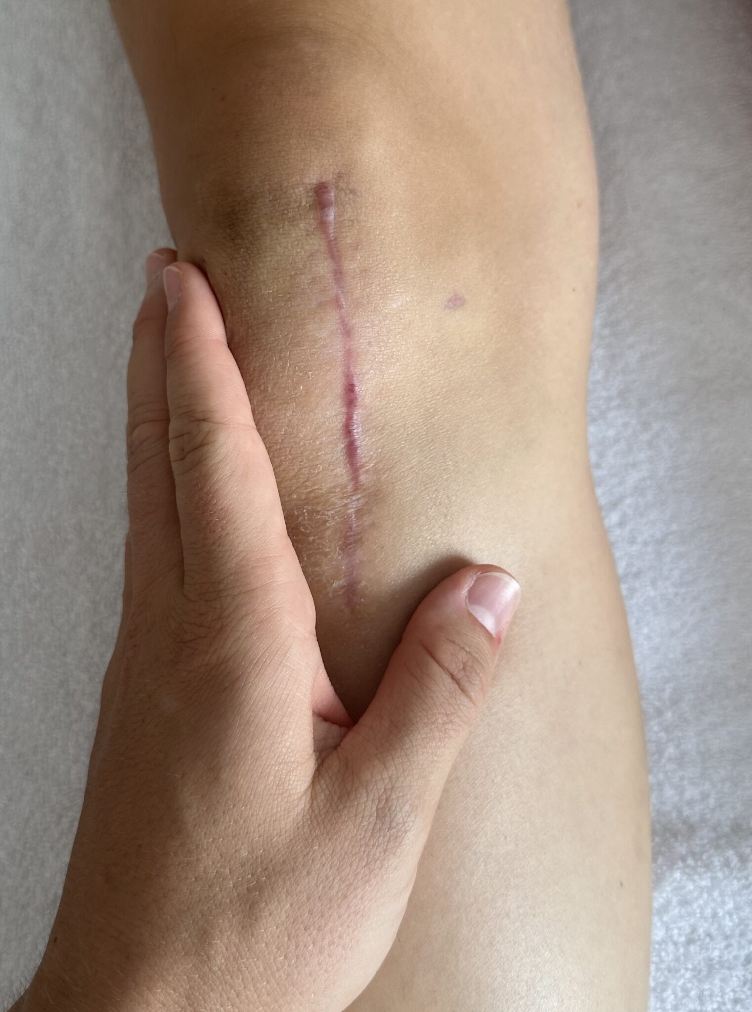 Narbenbehandlung Knie